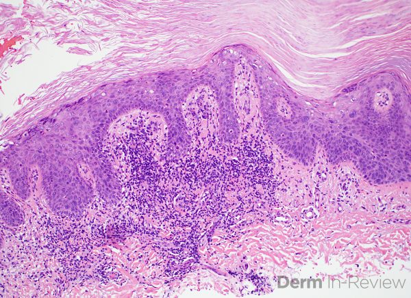 Figure 5.13.12 – Derm In-Review