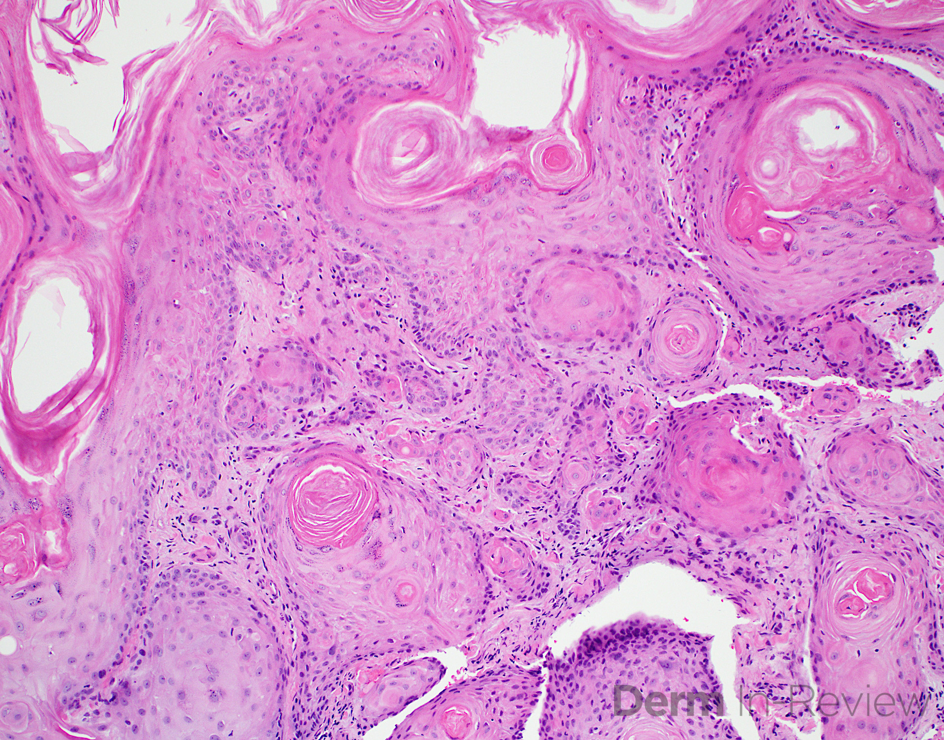 13.13 Squamous cell carcinoma