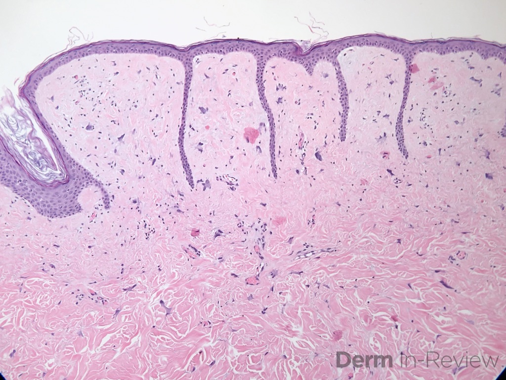 15.3 Pleomorphic fibroma