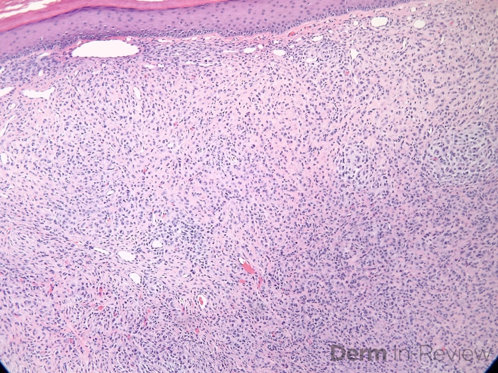 15.7 epithelioid cell histiocytoma