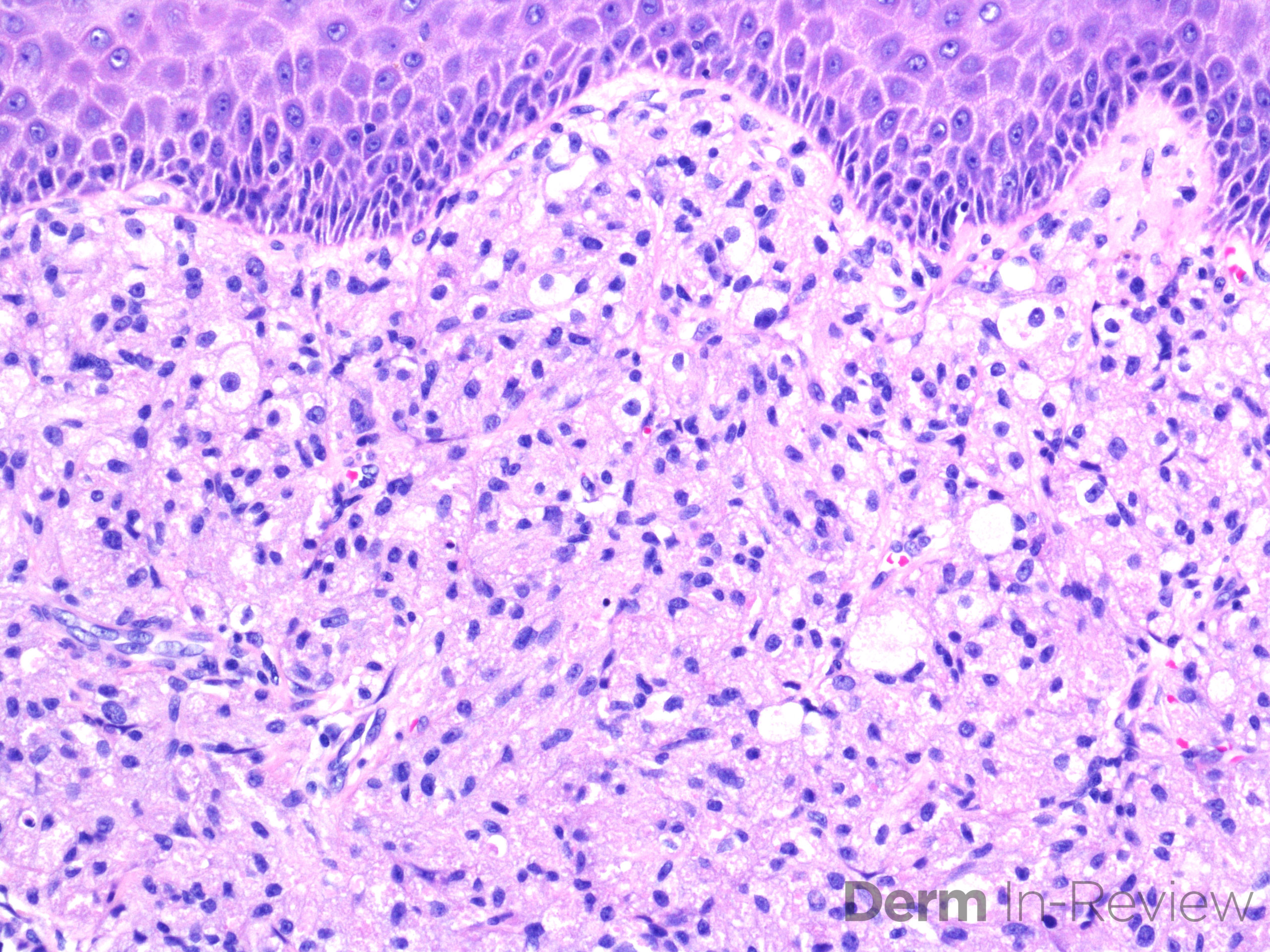 16.19-granular-cell-tumor