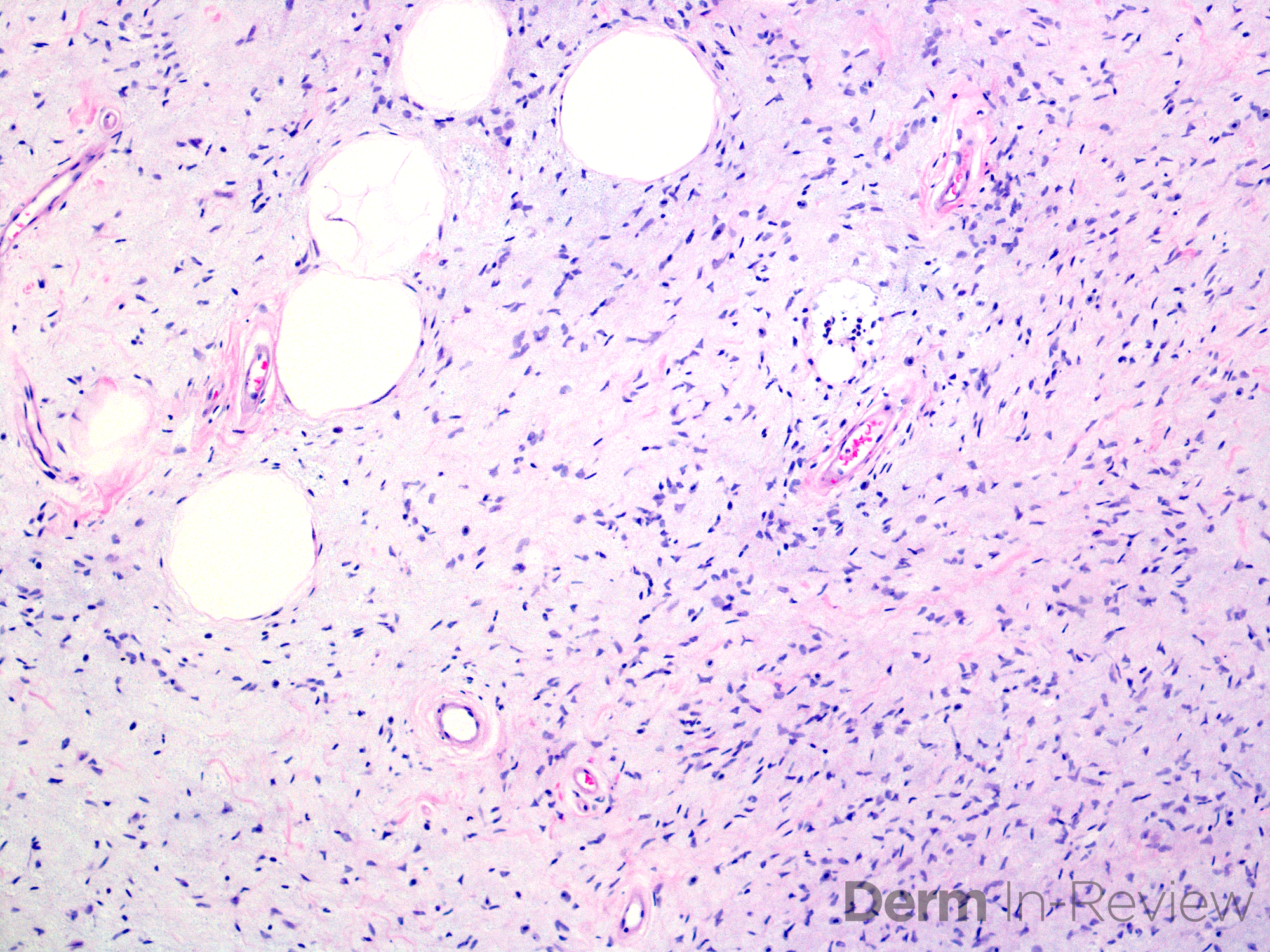 16.3 spindle cell lipoma
