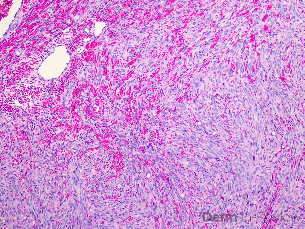 Figure 5.17.15 A-B – Derm In-Review