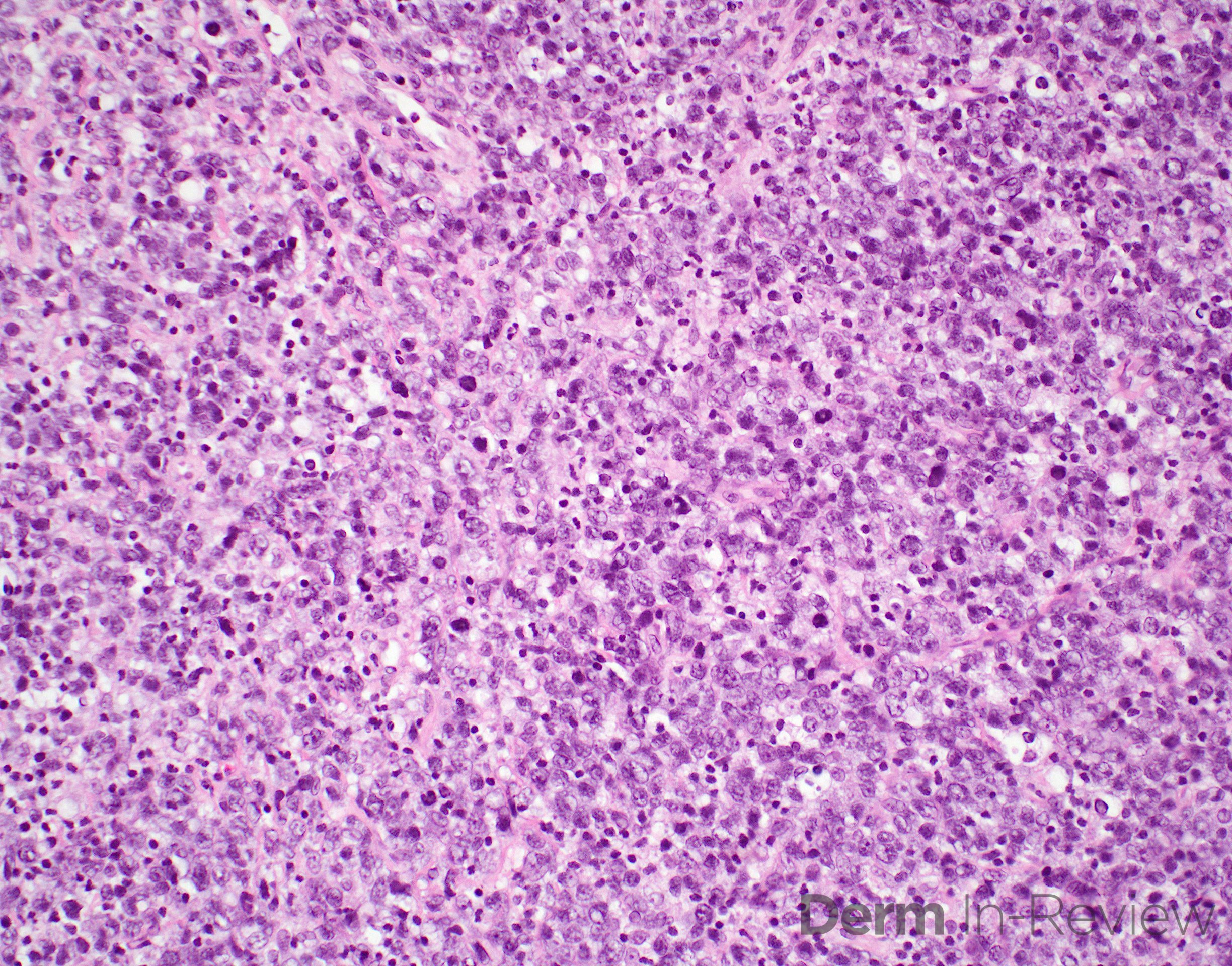 18.11B Diffuse large B-cell lymphoma, high power