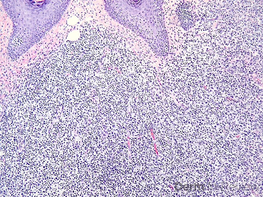 18.5A Anaplastic large cell lymphoma