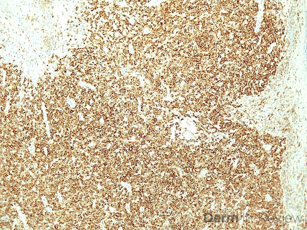 18.5B Anaplastic large cell lymphoma, CD30