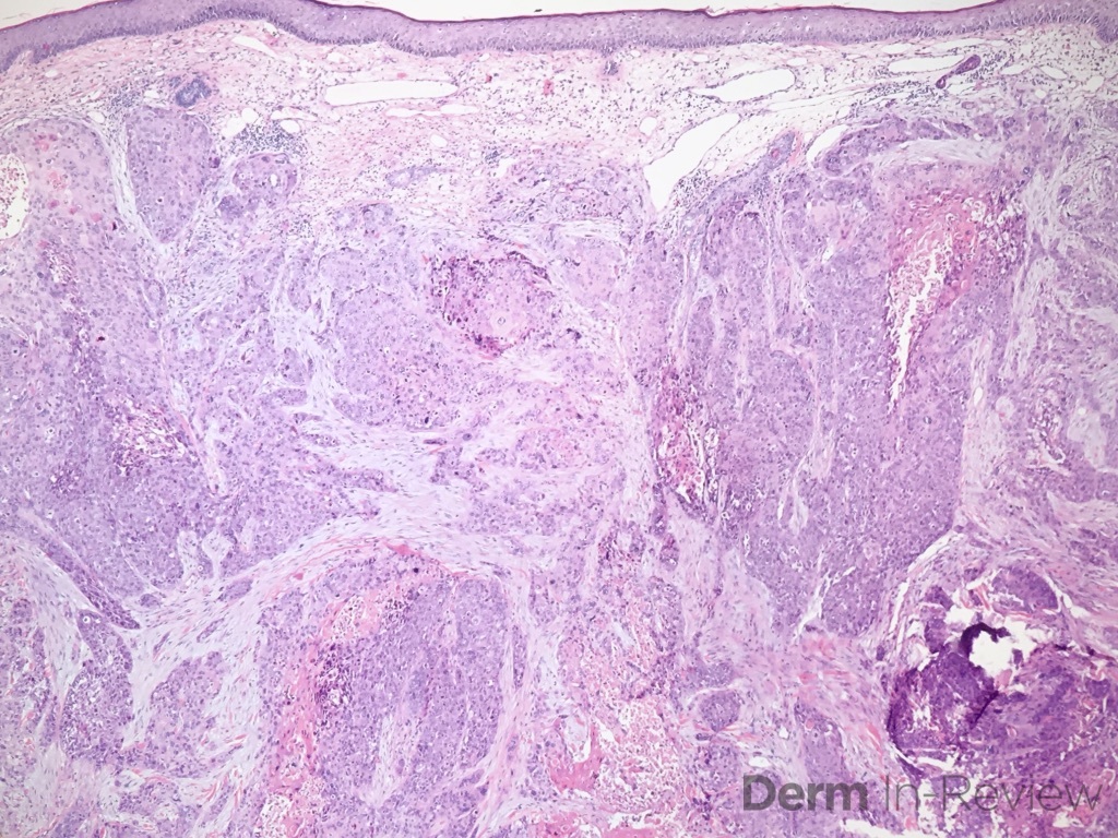 20.6A Metastatic lung squamous cell carcinoma
