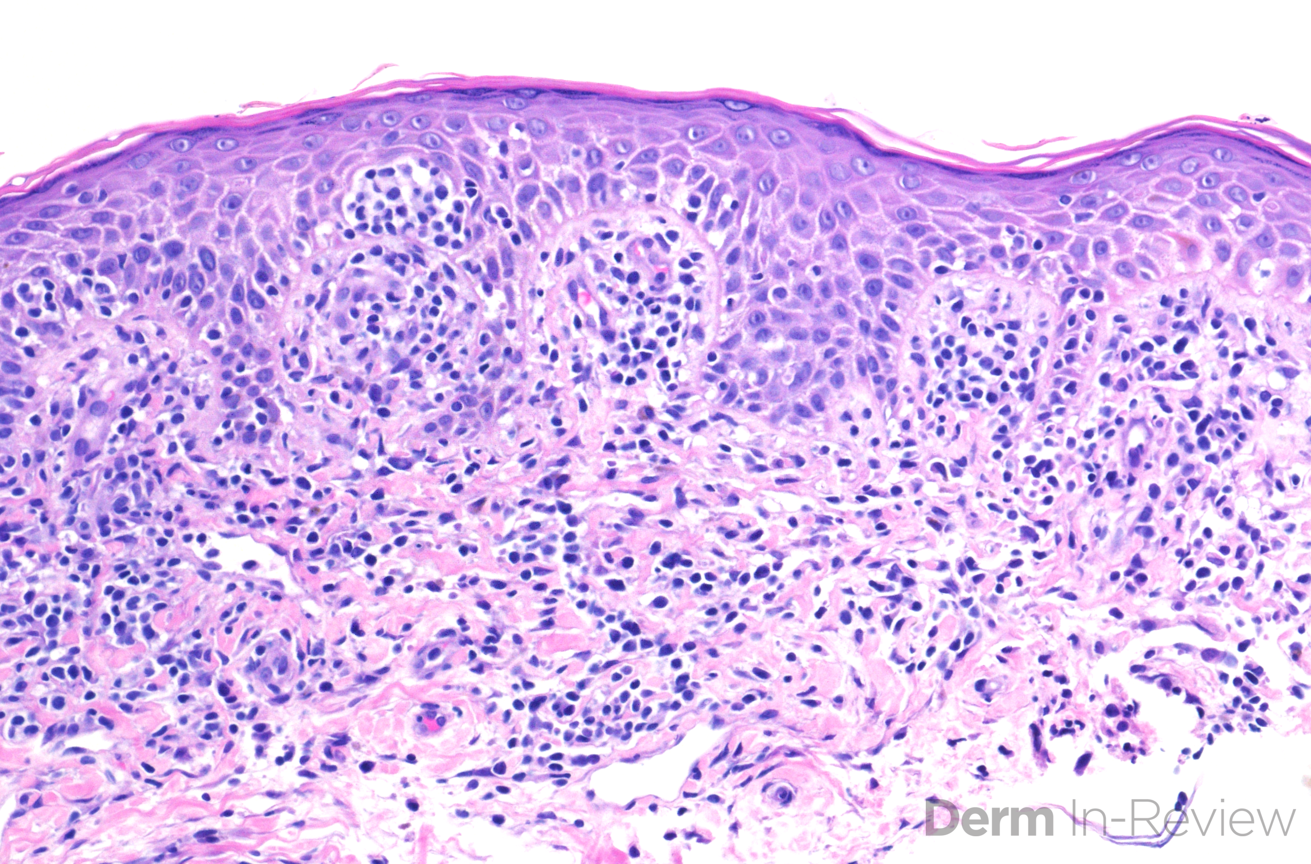 3.11 mycosis fungoides