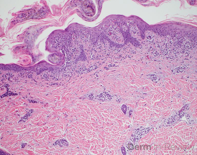 Figure 5.3.20 – Derm In-Review