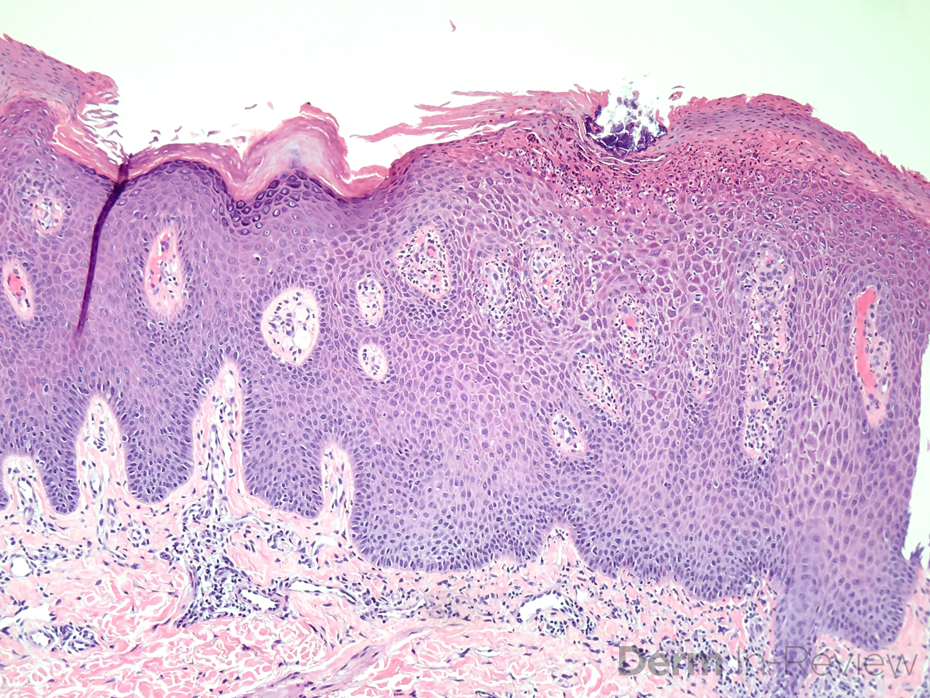 Inflammatory linear verrucous epidermal nevus