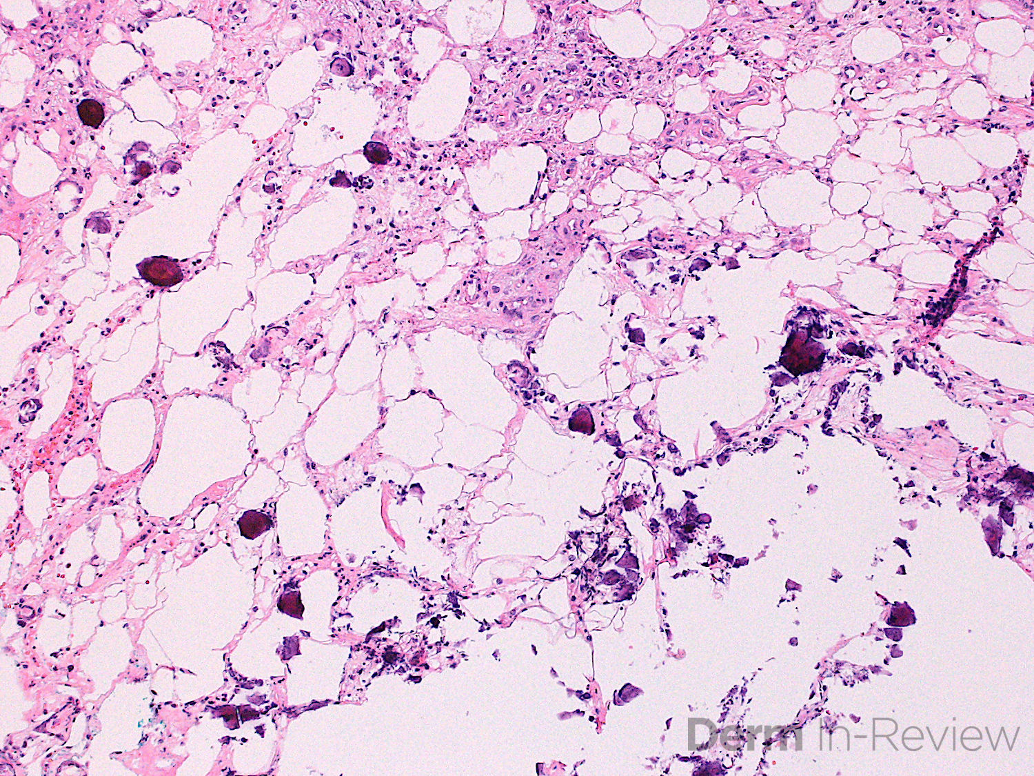 7.12A calciphylaxis