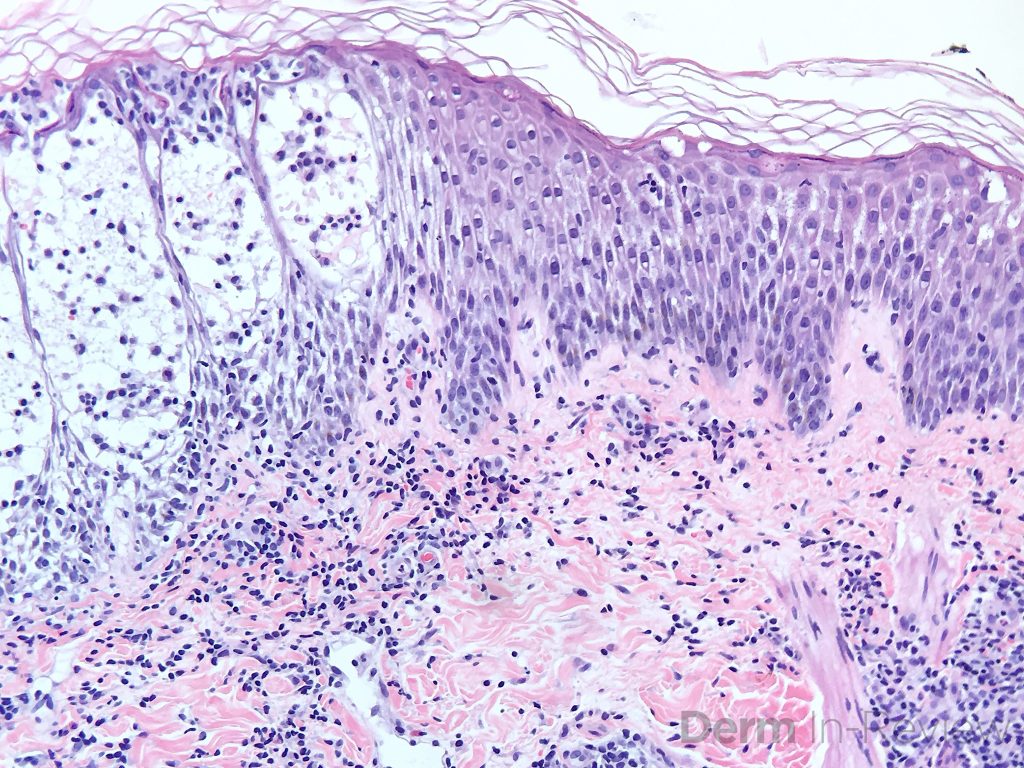 Figure 5.3.7 Spongiotic dermatitis. – Derm In-Review