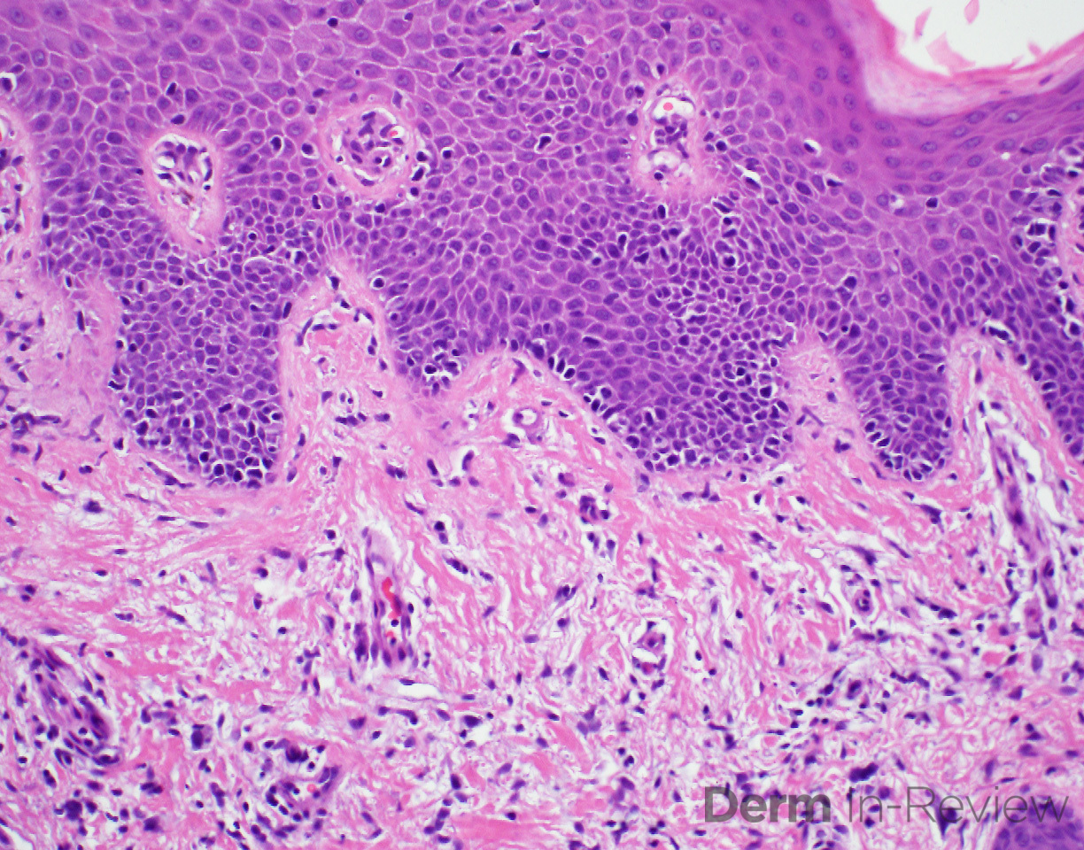 A Mycosis fungoides, patch stage