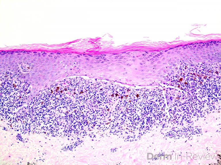 Figure 5.3.25 Lichenoid dermatitis differential. – Derm In-Review