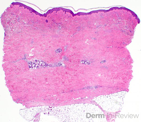 Figure 5.9.8 Sclerotic dermatoses. – Derm In-Review