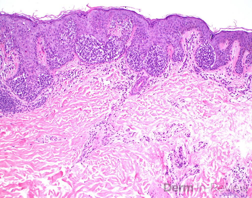 Figure 5.12.10 Comparison of conventional nevus, dysplastic nevus and ...