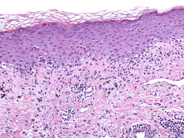 Figure 5.3.26 Acute interface dermatitis. – Derm In-Review