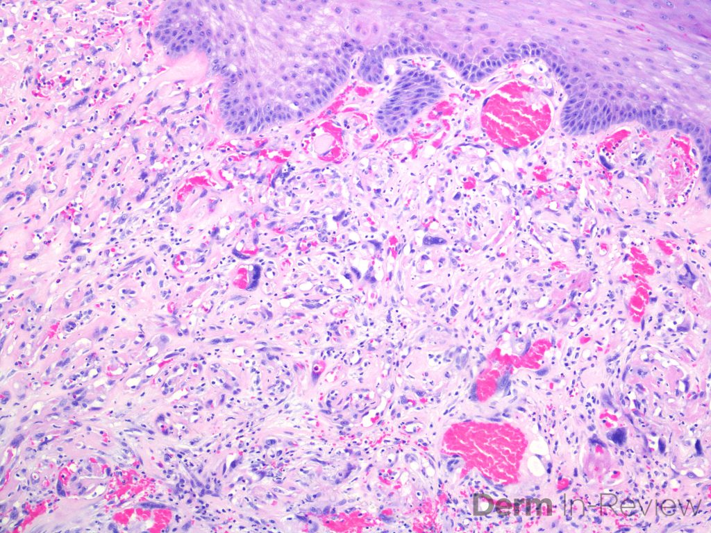 Figure 5.17.17 Vascular neoplasms. – Derm In-Review