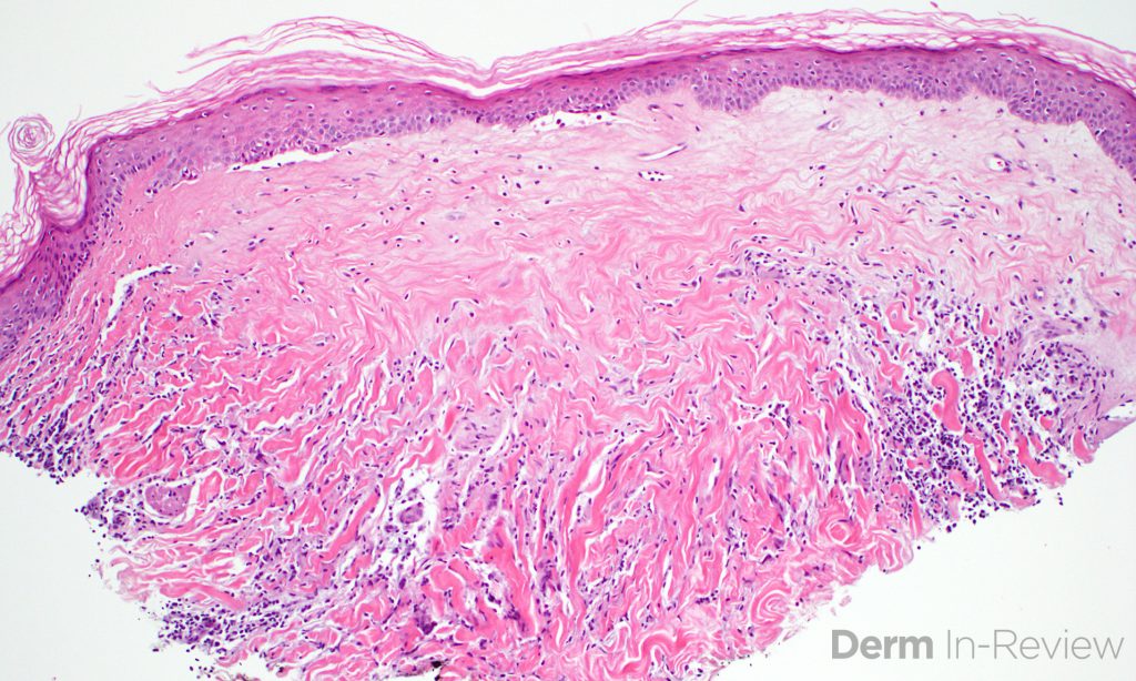 Figure 5.9.8 Sclerotic dermatoses. – Derm In-Review