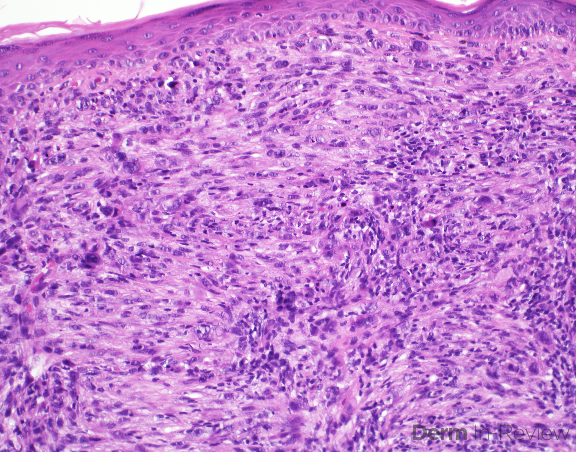 Figure 5.15.18 Differential diagnosis of cutaneous spindle cell